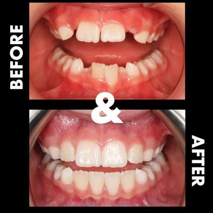 Orthodontics  Josie - Invisalign - Phase 1 Complete - Before