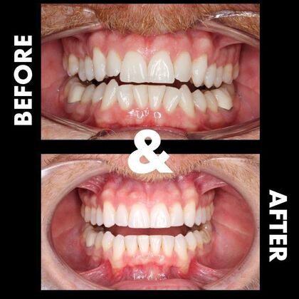 Orthodontics  Robby - Invisalign - Before