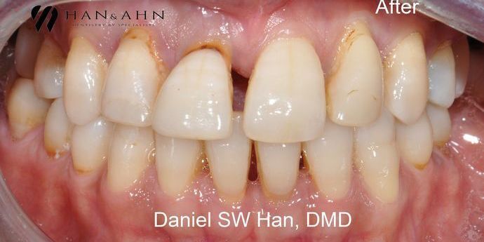 Full Mouth Reconstruction: Case 8 - Before