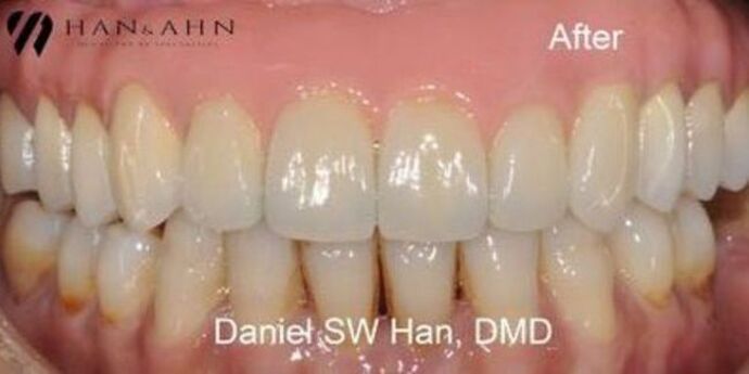 Full Mouth Reconstruction: Case 8 - After