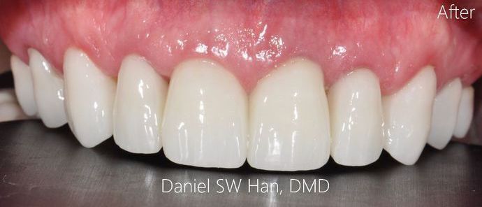 Full Mouth Reconstruction: Case 10 - Before