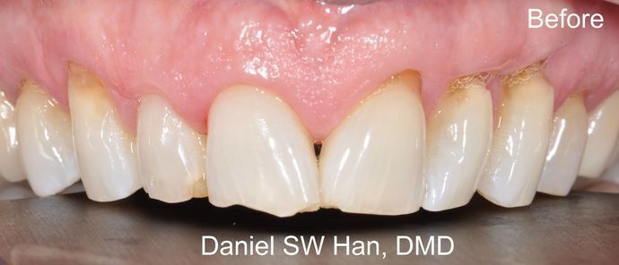 Cosmetic Dentistry: Case 1 - Before Cosmetic Makeover
