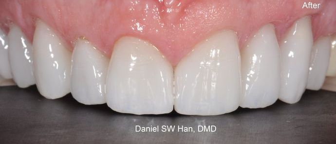 Cosmetic Dentistry: Case 1 - After Cosmetic Makeover