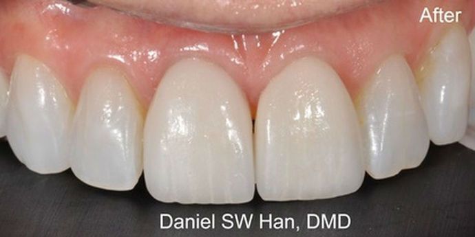 Cosmetic Dentistry: Case 2 - After Cosmetic Makeover