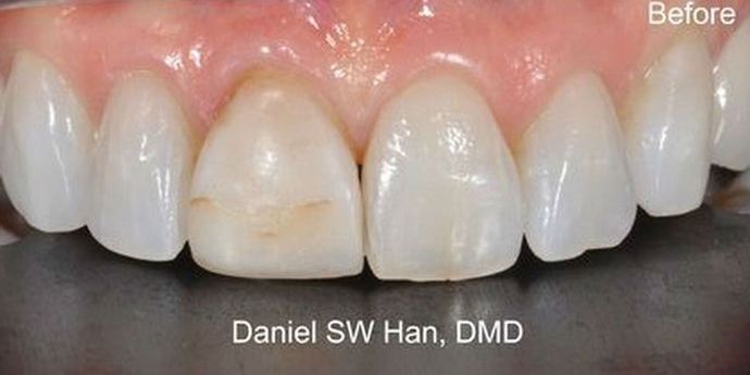 Cosmetic Dentistry: Case 2 - Before Cosmetic Makeover