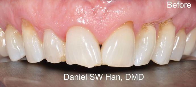 Cosmetic Dentistry: Case 1 - Before