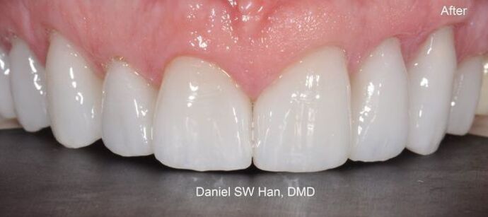 Cosmetic Dentistry: Case 1 - After