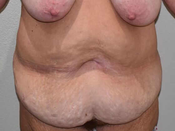 Tummy Tuck (Abdominoplasty): Case 505 - Before