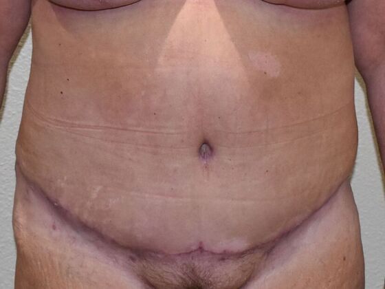 Tummy Tuck (Abdominoplasty): Case 505 - After