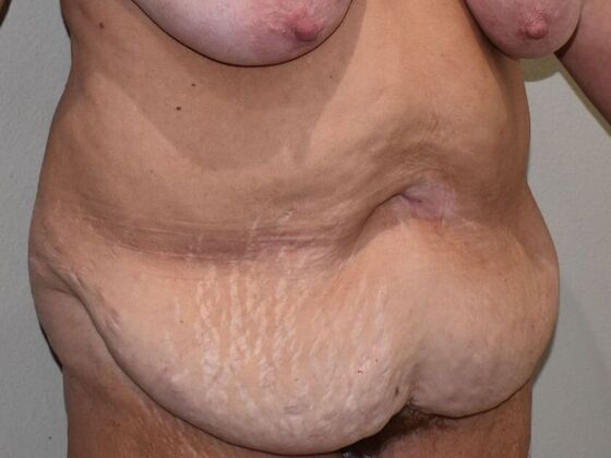 Tummy Tuck (Abdominoplasty): Case 505 - Before