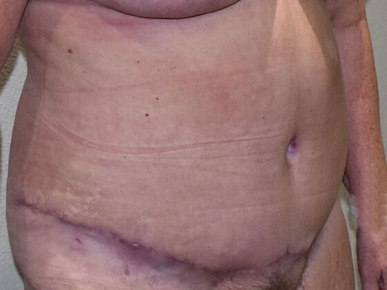 Tummy Tuck (Abdominoplasty): Case 505 - After