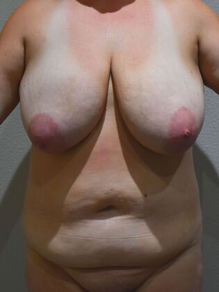 Massive Weight Loss : Case 4 - Before