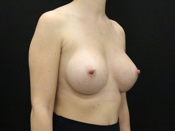 Breast Augmentation: Case 24 - After