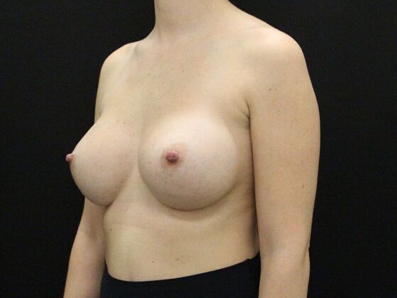 Breast Augmentation: Case 24 - After