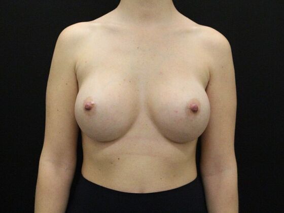 Breast Augmentation Case 24 - After