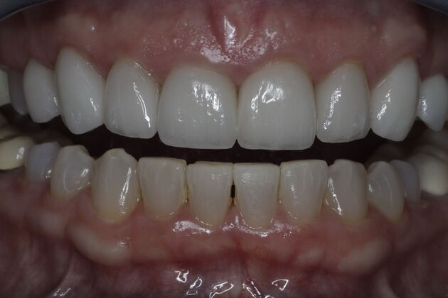 Cosmetic Dentistry Cosmetic Dentistry Case 11 - After
