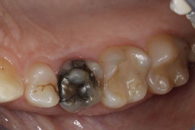 Cosmetic Dentistry: Cosmetic Dentistry Case 11 - Before