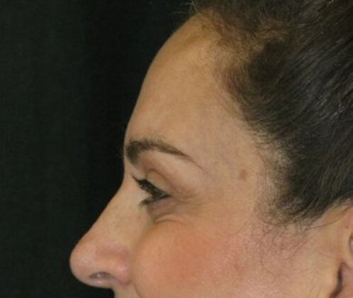 blepharoplasty (eyelid lift): Case 7 - After