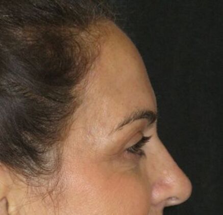 blepharoplasty (eyelid lift): Case 7 - Before