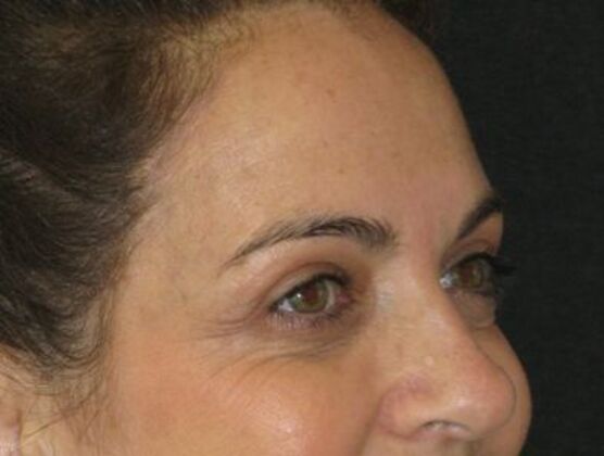 blepharoplasty (eyelid lift): Case 7 - After