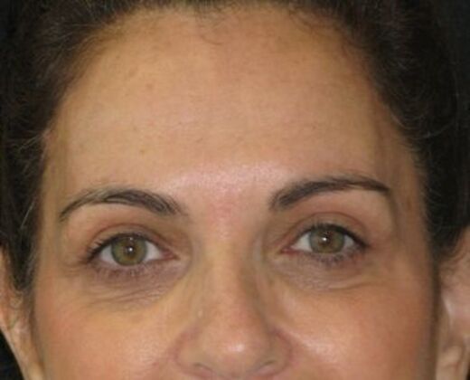 blepharoplasty (eyelid lift): Case 7 - After