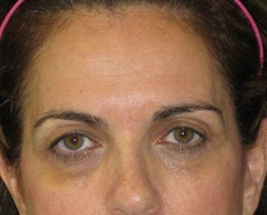 blepharoplasty (eyelid lift): Case 7 - Before