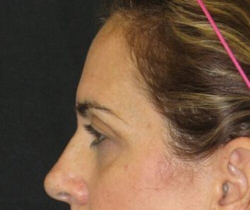 blepharoplasty (eyelid lift): Case 7 - Before