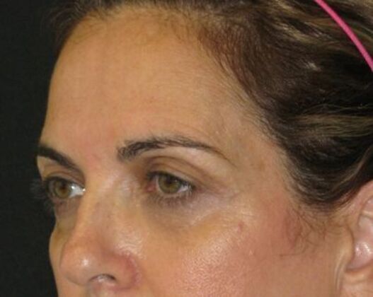 blepharoplasty (eyelid lift): Case 7 - Before