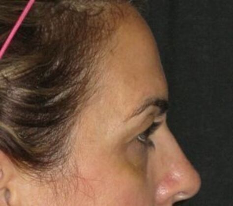 blepharoplasty (eyelid lift): Case 7 - Before