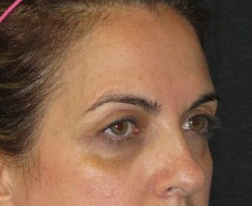 blepharoplasty (eyelid lift): Case 7 - Before