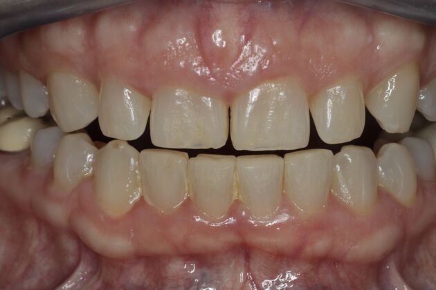 Cosmetic Dentistry: Cosmetic Dentistry Case 11 - Before