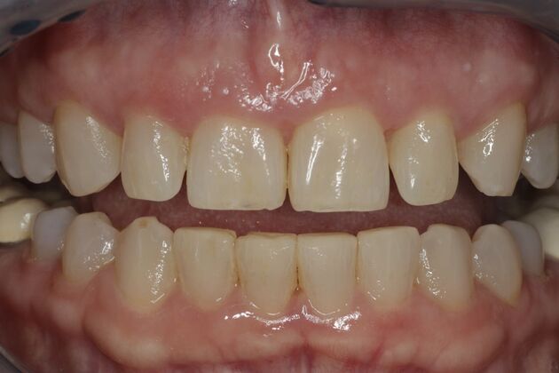 Laser Gum Reshaping Case 9 - After