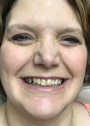 Dental Implants Case 4 - Before