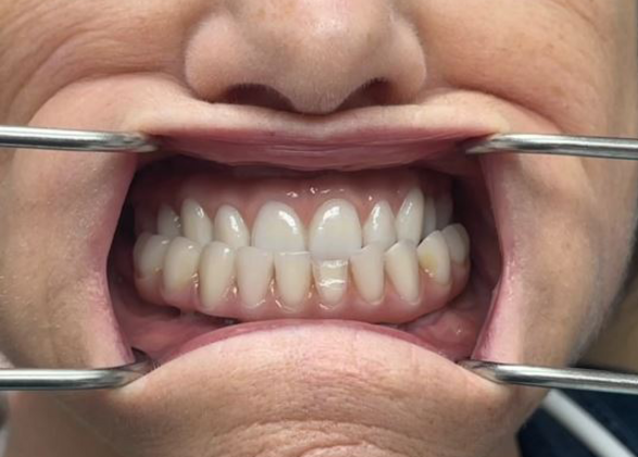 Dental Implants: Case 1 - Before