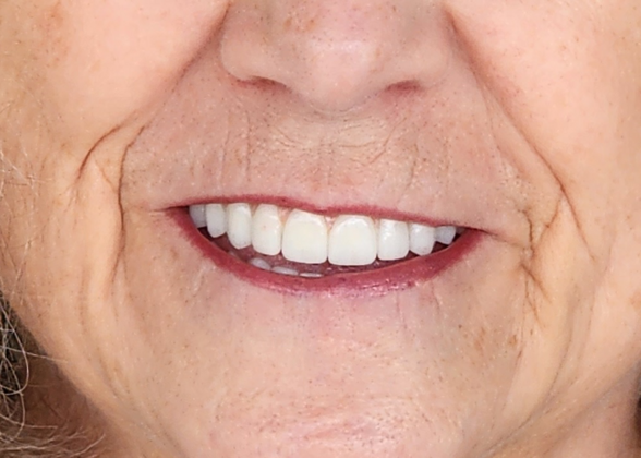 Dental Implants: Case 1 - After