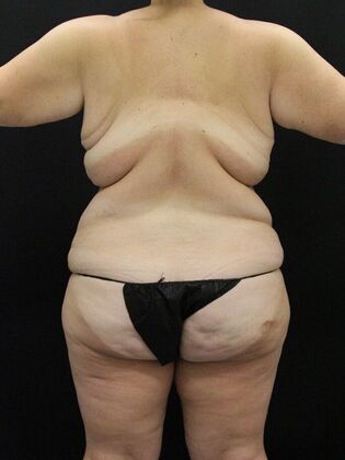 Liposuction: Case 32 - Before