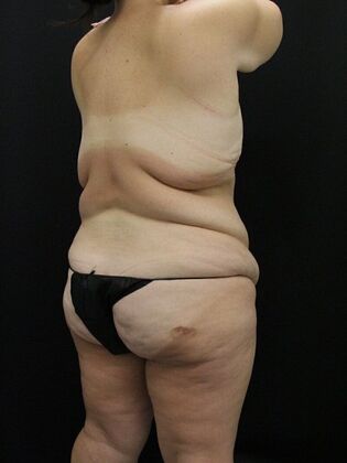 Liposuction: Case 32 - Before