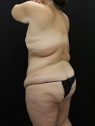 Liposuction: Case 32 - Before