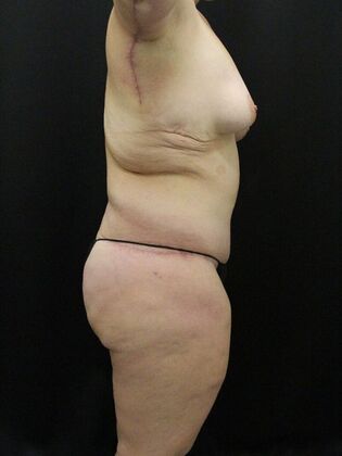 Liposuction: Case 32 - After