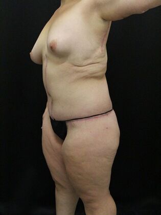Liposuction: Case 32 - After