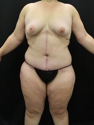 Liposuction: Case 32 - After