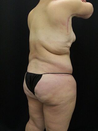 Liposuction: Case 32 - After