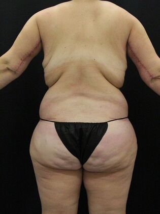 Liposuction: Case 32 - After