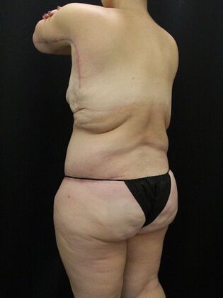 Liposuction: Case 32 - After