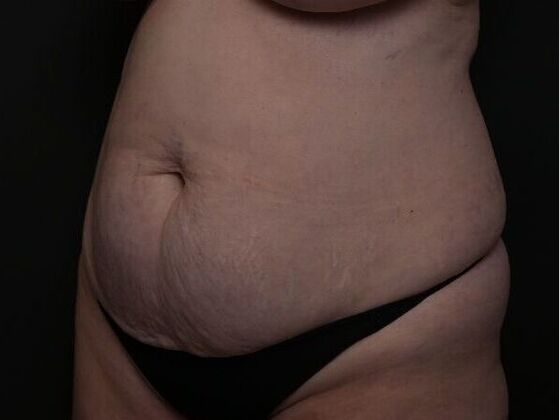 Tummy Tuck with Contouring: Case 3 - Before