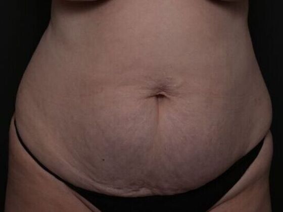 Tummy Tuck with Contouring Case 3 - Before