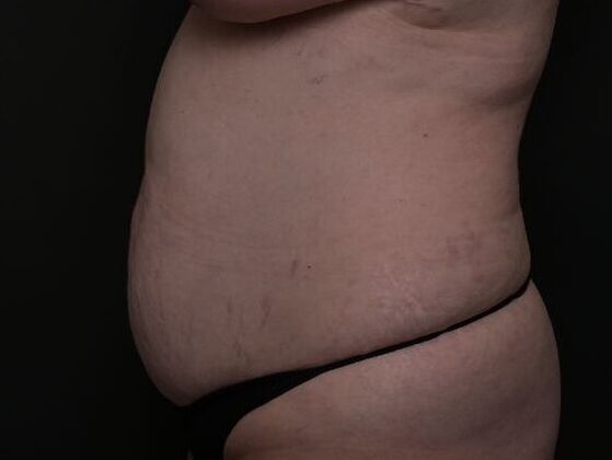 Tummy Tuck with Contouring: Case 3 - Before