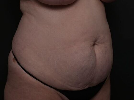 Tummy Tuck with Contouring: Case 3 - Before
