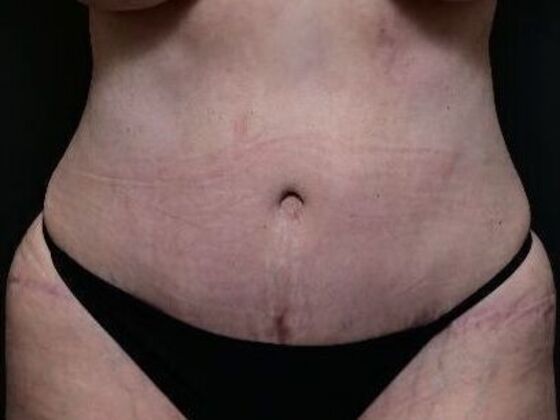 Tummy Tuck with Contouring Case 3 - After
