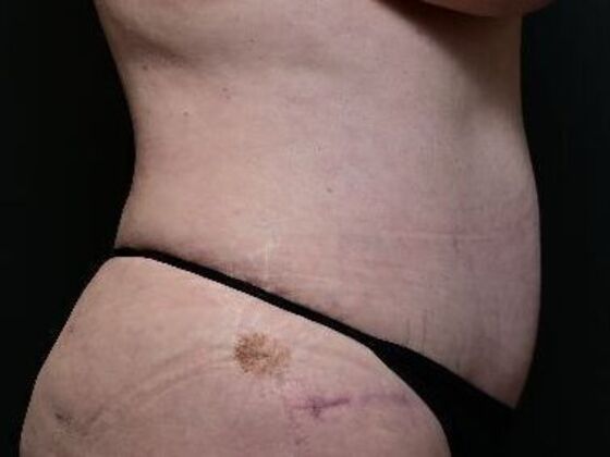 Tummy Tuck with Contouring: Case 3 - After